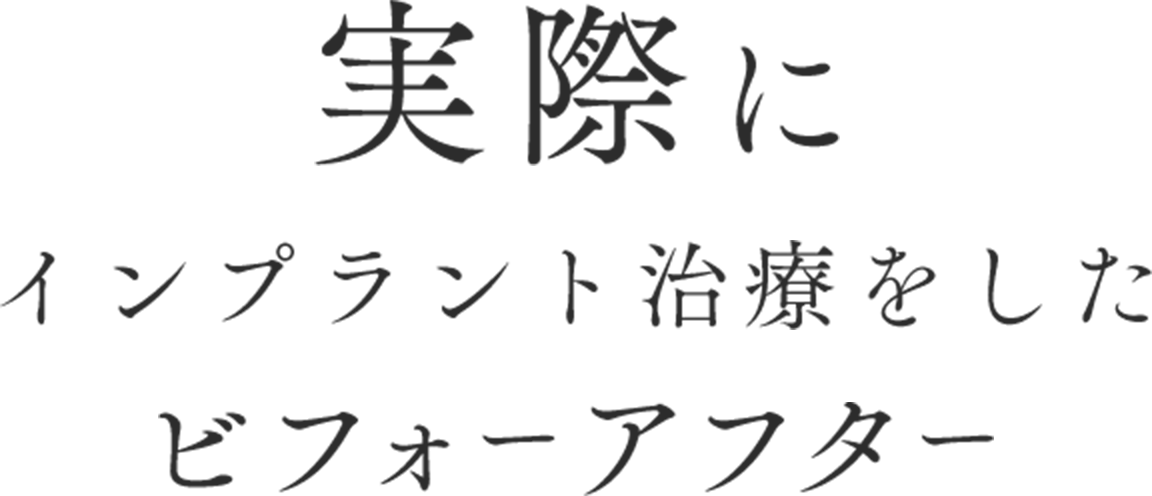 実際にインプラント治療をしたビフォーアフター